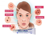 Dalacin T Gel 1% Acne Spot Treatment ( 2 tubes )