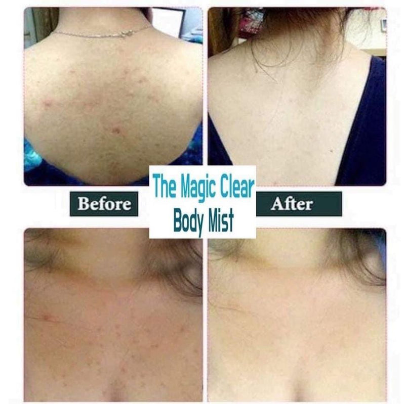 The magic Clear Body Mist (Body spray helps reduce back acne) - Vt Glamour
